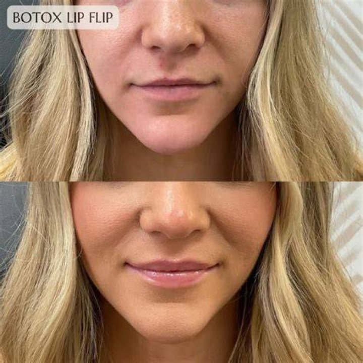 Botox Mishaps Edelstein Cosmetic