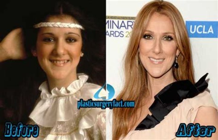 Celine Dion Nose Job Plastic Surgery Before and After