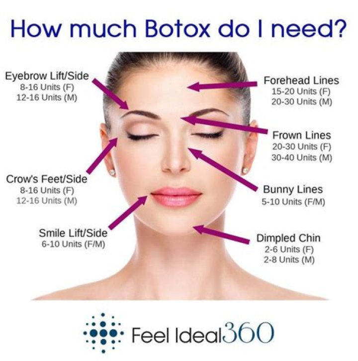 How Much Botox Do I Need tour bous