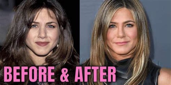 Jennifer Aniston Plastic Surgery Before and After Pictures