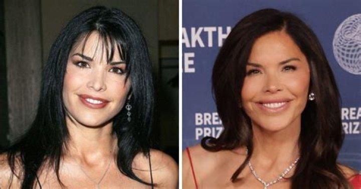 Lauren Sanchez Before and After Plastic Surgery Lips, Facelift, Botox