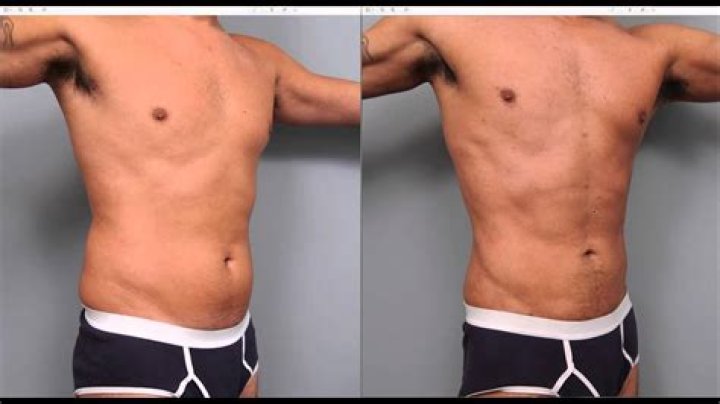 Liposuction for Men Dr. Sterry YouTube