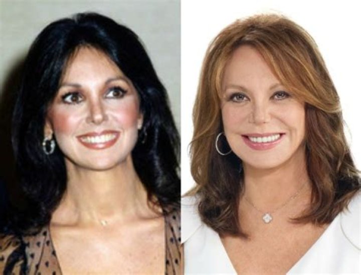 Marlo Thomas Plastic Surgery Before and After Photos