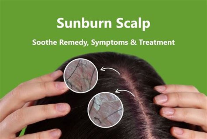 Scalp Burn Survivor Misty's Hair Restoration with CNC Hair Prosthesis