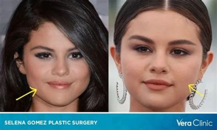 Selena Gomez Plastic Surgery Of Face, Nose and Breast With Before and